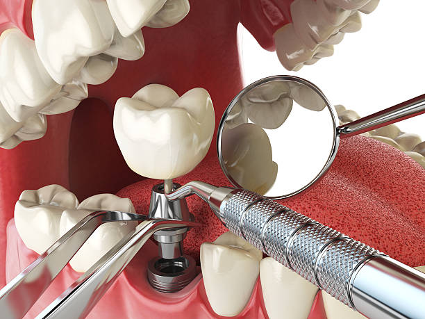 Best Chipped Tooth Repair Near Me  in Hominy, OK
